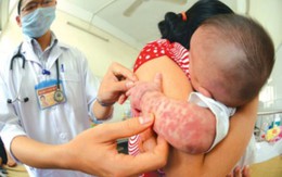 Bỏ tiêm vaccine, nhiều trẻ mắc sởi bị biến chứng nặng