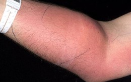 Tự tiêm tinh trùng vào tay người đàn ông 33 tuổi nhập viện gấp