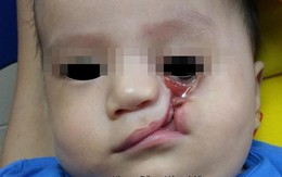 Bé trai 8 tháng ở Hà Tĩnh mắc bệnh hiếm khiến mặt biến dạng, nước mắt liên tục chảy tràn