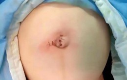Thấy con phình rốn, cặp vợ chồng thiếu hiểu biết vô tư dùng dao rọc giấy "phẫu thuật" gây ra cảnh tượng rùng mình