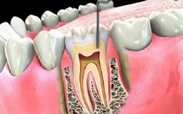 Khi nào cần điều trị viêm tủy răng?