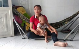 Đánh sưng má bé 19 tháng tuổi, bảo mẫu nói dối bé ngã cầu thang