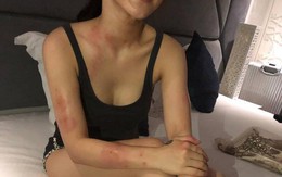 Hương Tràm bị dị ứng cấp tính, có nguy cơ biến chứng nặng