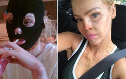 Kinh hoàng người mẫu Anh công bố bức ảnh bị bạn trai tạt axit