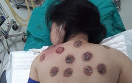 Hà Nội: Một phụ nữ hoải tử cả vùng lưng vì giác hơi