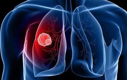 5 giải pháp đơn giản nhất để ngăn ngừa ung thư phổi: Mỗi người đều nên áp dụng sớm