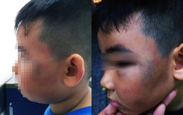 Phẫn nộ bé 8 tuổi bị đánh bầm tím mặt vì nghi trộm gà