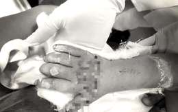 Bé gái 3 tuổi bị cán đứt bàn tay vì chiếc máy dập cốc
