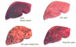 Giám đốc BV K hướng dẫn cách phòng bệnh ung thư có tỷ lệ mắc mới nhiều nhất tại Việt Nam