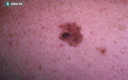 Những thay đổi trên da có thể là do các tế bào ung thư "quấy nhiễu": Hãy nhanh đi khám