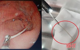Nuốt tăm lúc ngủ quên, người đàn ông ở TP Hà Tĩnh suýt thủng dạ dày