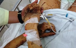 Việt kiều bị tạt a-xít, cắt gân chân ở Quảng Ngãi được đưa sang Canada điều trị