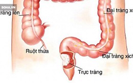 5 việc làm để ngăn chặn nguy cơ mắc ung thư trực tràng: Đừng để mầm bệnh lớn rồi mới biết