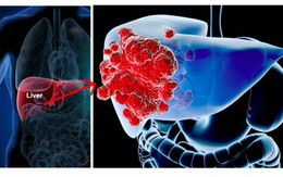 Ung thư gan đứng đầu trong các bệnh ung thư ở VN: GĐ BV Ung bướu chỉ 5 dấu hiệu cảnh báo