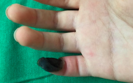 Con trai mất 1/3 ngón tay út vì cha mẹ tự chữa loại mụn bé tẹo này tại nhà