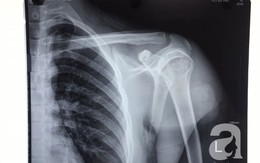 Xô xát khi đi chơi, thanh niên 20 tuổi bị nhóm người lạ phóng dao xuyên vai, liệt tay