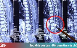 Không thể di chuyển do căn bệnh khó phát hiện trong ống sống