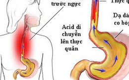 Trào ngược thực quản có thể biến chứng thành ung thư: GS tiêu hoá mách cách "sống chung"