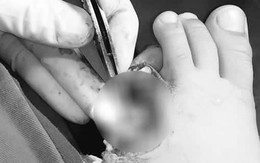 Kinh hoàng ốp ống pô inox Airblade cắt đứt ngón chân bé trai 6 tuổi