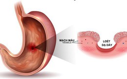 7 triệu chứng không đau có thể là dấu hiệu sớm của ung thư: Khám sớm có thể cứu sống bạn