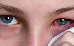 Sai lầm khiến người đau mắt đỏ có thể bị mù