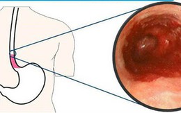 BS phát hoảng vì bệnh nhân nôn hàng lít máu tươi: "Thủ phạm" là thứ đồ uống nhiều người mê