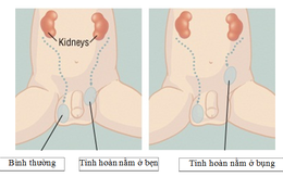 Tinh hoàn nằm trong ổ bụng, bé trai 5 tuổi được nội soi hạ về “đúng vị trí”