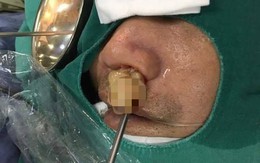 10 năm không thể ngửi được, bác sĩ lôi ra thủ phạm chình ình trong mũi người đàn ông U50