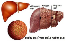 Giám đốc 40 tuổi bị ung thư gan vì làm 4 việc trong thời gian dài