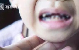 Cậu bé 3 tuổi có tới 16 chiếc răng bị mủn nát, do thói quen rất nhiều trẻ mắc phải