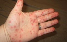 Nguyên nhân gây xuất huyết dưới da