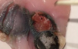Sự thật mọi cha mẹ nên biết: Hình ảnh ghi lại điều đáng sợ sẽ xảy ra nếu trẻ nuốt phải pin