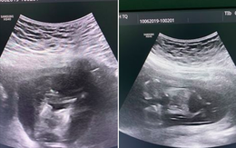 Cô gái Tuyên Quang mang song thai dính liền siêu hiếm, 2 bé chung 1 trái tim
