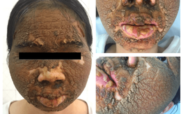 Đáng sợ hình ảnh cô gái trẻ mặt sùi như 'vỏ mít' sau khi dùng thuốc trắng da ở phòng khám tại Hà Nội