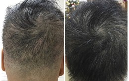 Phương pháp “thần kỳ” giúp tóc mọc dày gấp đôi tại bệnh viện Quốc tế DNA