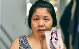 Uẩn khúc trong vụ người phụ nữ bị tạt axit 5 năm không tìm ra hung thủ