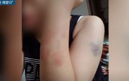 Hình ảnh đau lòng về thương tích của người vợ Việt vừa bị chồng Hàn đánh đập