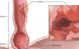 Bác sĩ khuyến cáo 3 yếu tố phổ biến có thể gây ung thư thực quản, ai cũng nên tránh