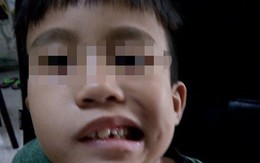 Ngủ dậy, bé trai 8 tuổi hốt hoảng vì bị lệch mặt, méo miệng, mắt không thể nhắm kín