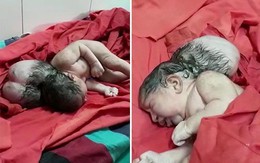 Trẻ sơ sinh 3 đầu như "người ngoài hành tinh" khiến các bác sĩ choáng váng