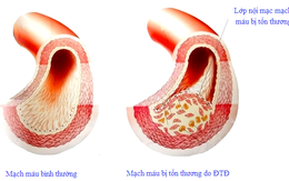 Bệnh của mạch máu có liên quan đến tai