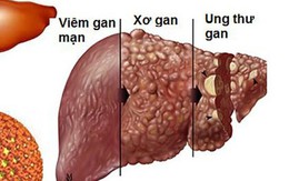 25.000 người chết vì ung thư gan mỗi năm, cách nào phát hiện sớm?