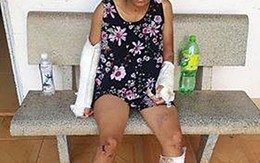 Bình Thuận: Vợ bị chồng đánh gãy 2 tay 1 chân