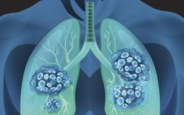 Sản phẩm Tumolung – Bước đột phá mới trong việc phòng ngừa và hỗ trợ điều trị u phổi
