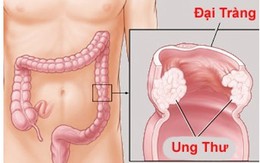 Bác sĩ cảnh báo: Bị đau bụng âm ỉ, có thể bạn đã bị ung thư nhưng không hề biết