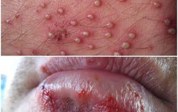 Các bệnh ngoài da do virus là gì và cách điều trị hiệu quả như thế nào?