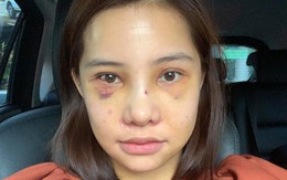 Lưu Đê Ly khoe trải qua 6 ca phẫu thuật ở Hàn để 'đập mặt làm lại', đẹp hay không chưa bàn chỉ biết là quá dũng cảm rồi!