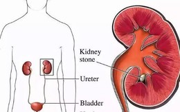 Người mẹ đang cho con bú phải cắt thận trái, thủ phạm là thói quen nhiều người mắc