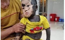 Nhói lòng hình ảnh bé trai 20 tháng tuổi với làn "da chó", mồ côi mẹ, không tiền chữa trị