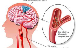 Sai lầm nhiều người mắc khi sơ cứu người bị đột quỵ khiến bệnh trầm trọng hơn